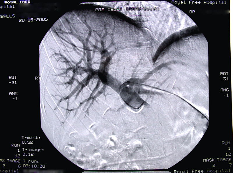 Radiographic image of the portal vein and its branches in the transplant recipient before infusion of isolated islets.