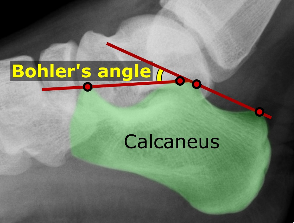 File:Bohler's angle (raster).jpg
