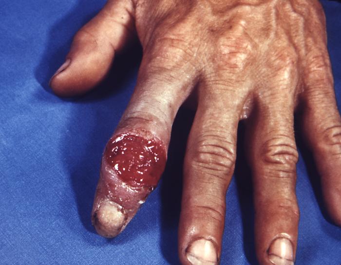 This patient presented with an extragenital syphilitic chancre of the left index finger. The chancre is usually firm, round, small, and painless, appearing at the spot where syphilis entered the body, and lasts 3-6 weeks, healing on its own. If adequate treatment is not administered, the infection progresses to the secondary stage. Adapted from CDC