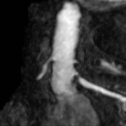 MRA: Renal artery stenosis.