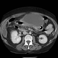 Perforated cholecystitis with subphrenic abscess.