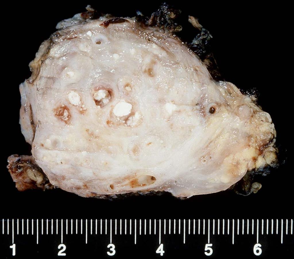 Case courtesy of Dr Henry Knipe, <a href="https://radiopaedia.org/">Radiopaedia.org</a>. From the case <a href="https://radiopaedia.org/cases/27870">rID: 27870</a>