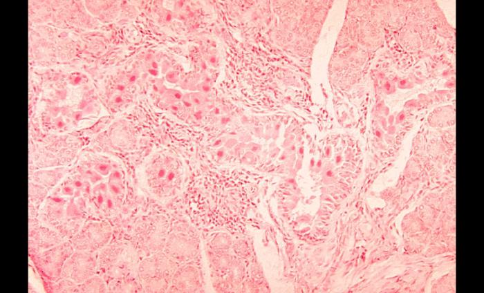 Histopathology of cytomegalovirus infection of salivary gland. From Public Health Image Library (PHIL). [1]