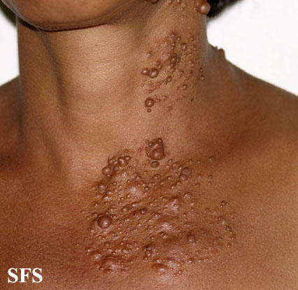Segmental neurofibromatosis. Adapted from Dermatology Atlas.[3]