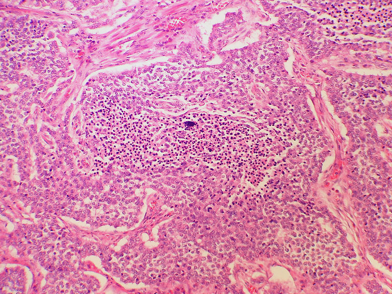 Appendiceal carcinoid with necrosis[6]