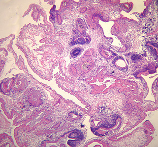 Coenurus removed from a subcutaneous nodule in the shoulder area of a patient, stained with hematoxylin and eosin (H&E). Image taken at 50x magnification. Although the species was not identified in this case, the pathology is consistent with T. serialis. Adapted from CDC