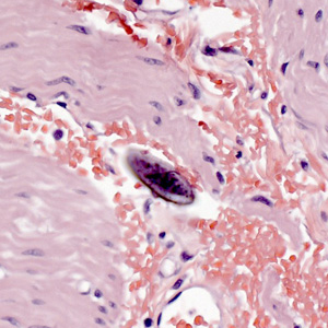 Egg of E. vermicularis in a colon biopsy specimen, stained with H&E. Adapted from CDC