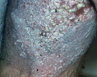 Hyperkeratotic changes in the skin