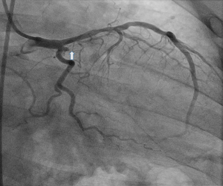 Figure 1. Coronary angiography demonstrates the total occlusion (arrow) of the first obtuse marginal branch 86 months after placement of a Sirolimus eluting-stent.