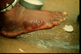 After rupture of the blister, the worm emerges as a whitish filament in the center of a painful ulcer which is often secondarily infected. (Images contributed by Global 2000/The Carter Center, Atlanta, Georgia). Adapted from CDC