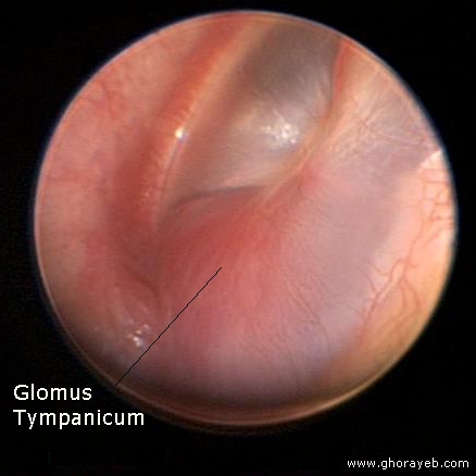 Glomus tympanicum magnified[2].