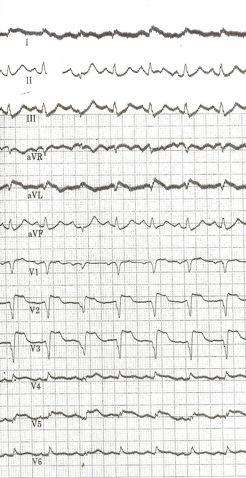 ECG on admission: A large anterior wall infarction