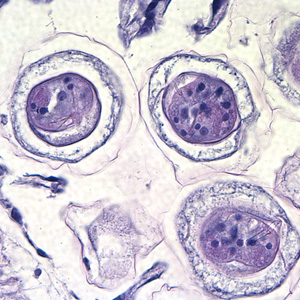 Higher magnification of the eggs in Figures 1 and 2, taken at 1000x, oil. Hooks do not stain with H&E but are refractile and may be visible in stained specimens with proper adjustment of the microscope. Polar filaments are visible in the egg in the upper right quadrant of the image. Adapted from CDC