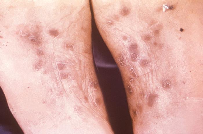 This image depicts the soles of a patient's feet, who’d presented with an outbreak of plantar syphilids, due to what was diagnosed as a secondary syphilitic infection. The secondary stage of syphilis is characterized by the manifestation of a skin rash and mucous membrane lesions. This stage typically starts with the development of a rash on one or more areas of the body. The rash usually does not cause itching. Rashes associated with secondary syphilis can appear as the chancre is healing or several weeks after the chancre has healed. The characteristic rash of secondary syphilis may appear as rough, red, or reddish brown spots both on the palms of the hands and the bottoms of the feet. However, rashes with a different appearance may occur on other parts of the body, sometimes resembling rashes caused by other diseases. Sometimes rashes associated with secondary syphilis are so faint that they are not noticed. In addition to rashes, symptoms of secondary syphilis may include fever, swollen lymph glands, sore throat, patchy hair loss, headaches, weight loss, muscle aches, and fatigue. The signs and symptoms of secondary syphilis will resolve with or without treatment, but without treatment, the infection will progress to the latent and possibly late stages of disease. Adapted from CDC