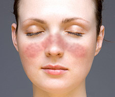 File:Lupus facial rash.jpg