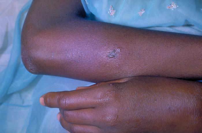 Note the gonococcal lesion on the skin of the left arm due to the bacterium Neisseria gonorrhoeae. N. gonorrhoeae, a gram-negative diplococcus, is the causative agent for Gonorrhea. Though these bacteria can infect the genital tract, the mouth, and the rectum, they can become disseminated throughout a person’s bloodstream. Adapted from CDC