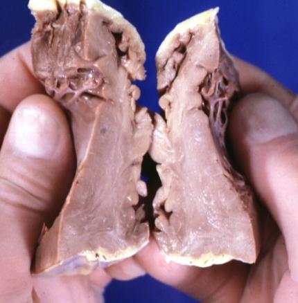 Cardiomyopathy: Gross interventricular septum showing asymmetrical hypertrophy in posterior septum