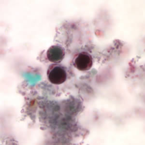 B. hominis cyst-like forms stained with trichrome. The nuclei in the peripheral cytoplasmic rim are visible, staining purple. Adapted from CDC
