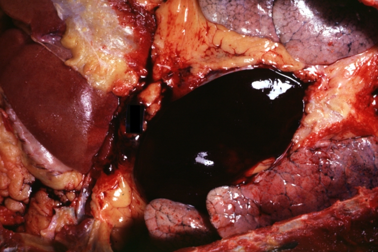 Hemopericardium: Gross, an excellent in situ view