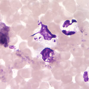 Leishmania (Viannia) panamensis amastigotes in a Giemsa-stained tissue scraping. Adapted from CDC