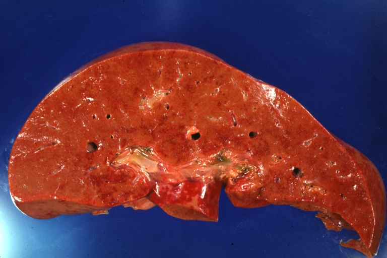 Lupus Erythematosus Hepatitis: Gross natural color. A 19yo female with lupus erythematosus and hepatitis characterized by periportal cell necrosis and sinus thrombosis cause uncertain photo shows focal grid-like hyperemia