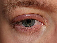 Blepharitis of the right eye - By clubtable - Own work (Original text: eigenes Foto), Public Domain, https://commons.wikimedia.org/w/index.php?curid=20138102