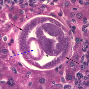Cross section of C. hepatica in liver tissue, stained with H&E. Note the presence of the intestine (blue arrow) and bacillary bands (black arrows). Adapted from CDC
