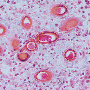Eggs of C. hepatica in liver stained with H&E. Adapted from CDC
