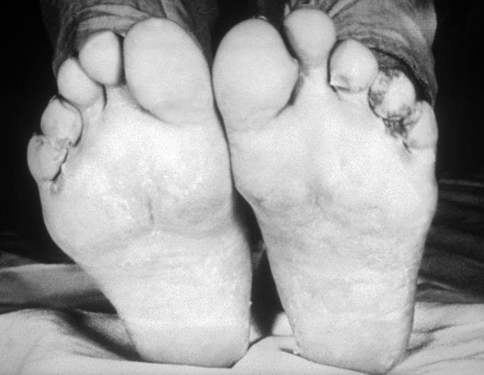 A photograph of syphilitic papules in the intertriginous areas of the toes. A patient with moist papules developing in the intertriginous areas between the toes. This clinical manifestation occurs during the secondary stage of syphilis, and is caused by the bacterium Treponema palladium. Adapted from CDC
