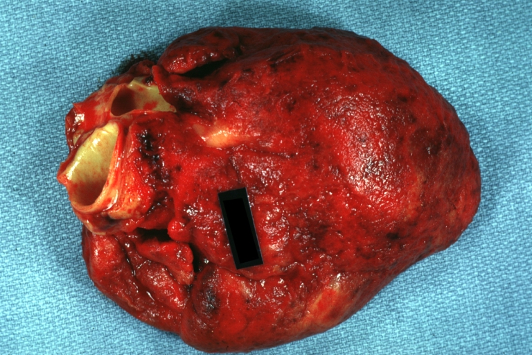 Tuberculous pericarditis: Gross, natural color, shaggy hemorrhagic exudate. This case is much more hemorrhagic than the typical tuberculous pericarditis.