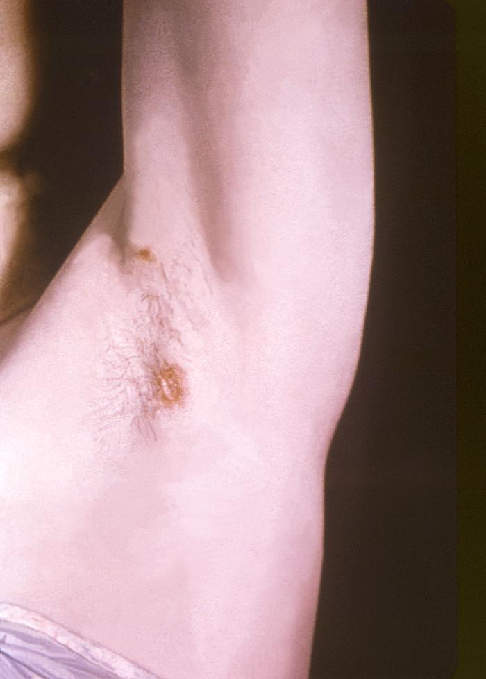 This image depicts the left axillary region of a female patient, who’d presented with what was described as condylomata lata lesions, due to what was diagnosed as a case of secondary syphilis. The secondary stage of syphilis is characterized by the manifestation of a skin rash and mucous membrane lesions. This stage typically starts with the development of a rash on one or more areas of the body. The rash usually does not cause itching. Rashes associated with secondary syphilis can appear as the chancre is healing or several weeks after the chancre has healed. The characteristic rash of secondary syphilis may appear as rough, red, or reddish brown spots both on the palms of the hands and the bottoms of the feet. However, rashes with a different appearance may occur on other parts of the body, sometimes resembling rashes caused by other diseases. Sometimes rashes associated with secondary syphilis are so faint that they are not noticed. In addition to rashes, symptoms of secondary syphilis may include fever, swollen lymph glands, sore throat, patchy hair loss, headaches, weight loss, muscle aches, and fatigue. The signs and symptoms of secondary syphilis will resolve with or without treatment, but without treatment, the infection will progress to the latent and possibly late stages of disease. Adapted from CDC