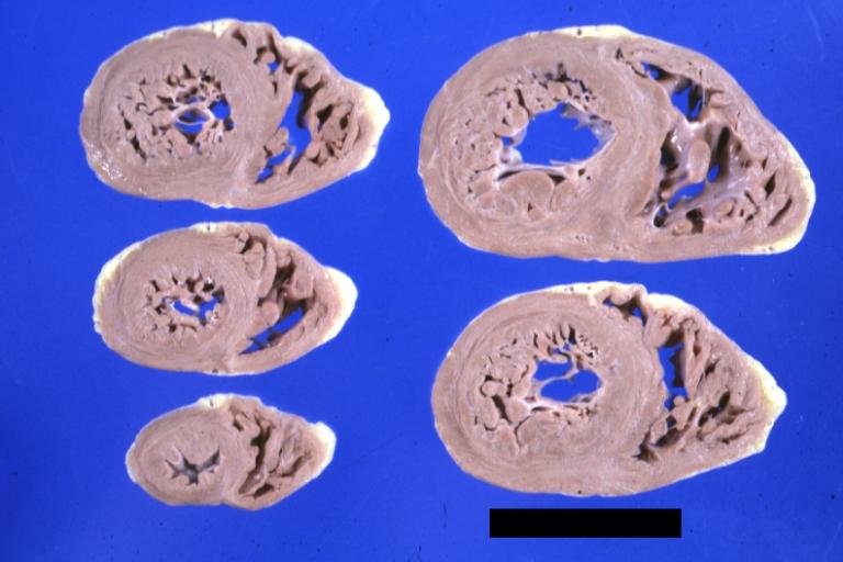 Cardiomyopathy: Gross montage of ventricular slices showing hypertrophy and about normal ventricular lumen size a hypertrophic non-dilated cardiomyopathy