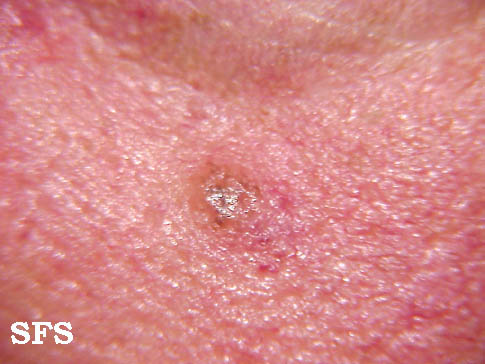 Naevus compound. Adapted from Dermatology Atlas.[1]