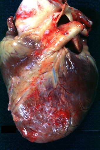 Fibrinous pericarditis: Gross, external view of localized pericarditis over an acute infarction