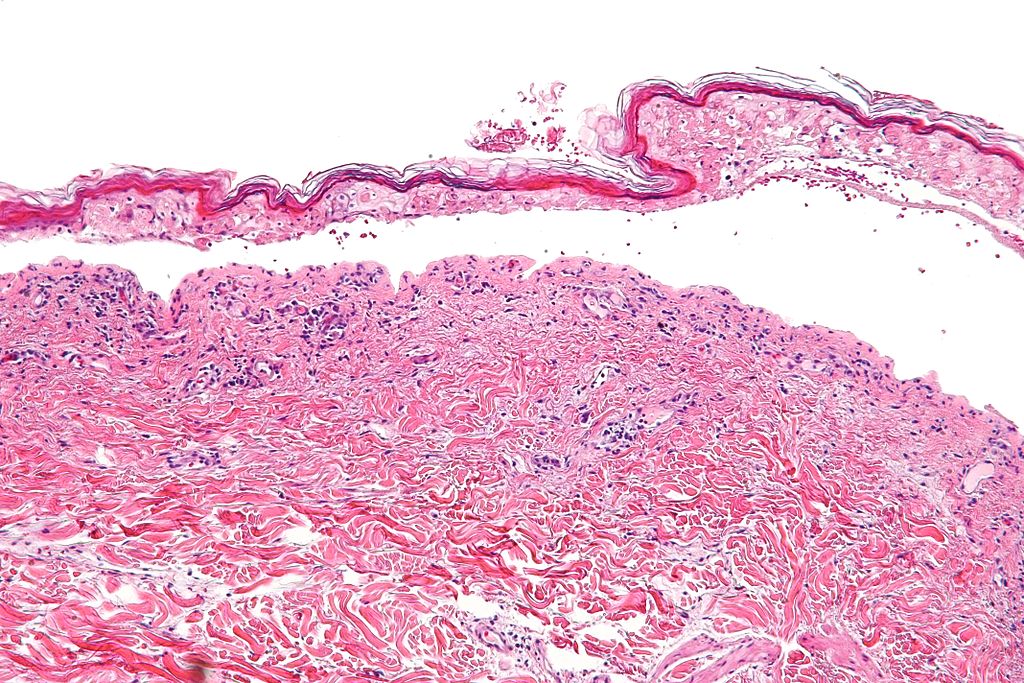 Histology of confluent epidermal necrosis (intermed mag)Source:By Nephron - Own work, CC BY-SA 3.0, https://commons.wikimedia.org/w/index.php?curid=16874054[10]