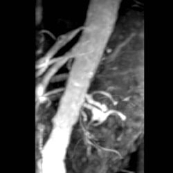 File:Renal artery stenosis 018.jpg