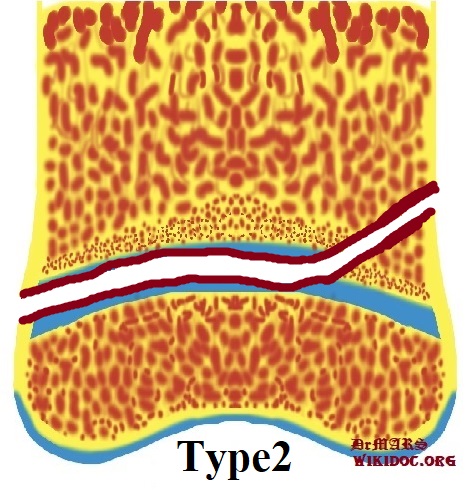 File:Type 2 Salter-Harris classification.jpg