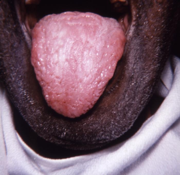 This image depicts the dorsal surface of the tongue in the case of an elderly African-American male, due to what was determined to be a secondary syphilitic infection. Note the furrowed appearance, and the papillae-free, i.e., desquamated, smooth lingual surface. Rashes associated with secondary syphilis can appear as the chancre is healing or several weeks after the chancre has healed. The characteristic rash of secondary syphilis may appear as rough, red, or reddish brown spots both on the palms of the hands and the bottoms of the feet. However, rashes with a different appearance may occur on other parts of the body, sometimes resembling rashes caused by other diseases. Sometimes rashes associated with secondary syphilis are so faint that they are not noticed. In addition to rashes, symptoms of secondary syphilis may include fever, swollen lymph glands, sore throat, patchy hair loss, headaches, weight loss, muscle aches, and fatigue. The signs and symptoms of secondary syphilis will resolve with or without treatment, but without treatment, the infection will progress to the latent and possibly late stages of disease. Adapted from CDC