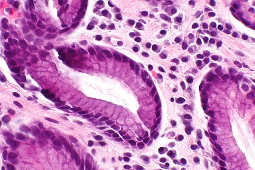 Chronic gastritis - Very-High Magnification, By Nephron (Own work) [CC BY-SA 3.0 (https://creativecommons.org/licenses/by-sa/3.0) or GFDL (http://www.gnu.org/copyleft/fdl.html)], via Wikimedia Commons [8]