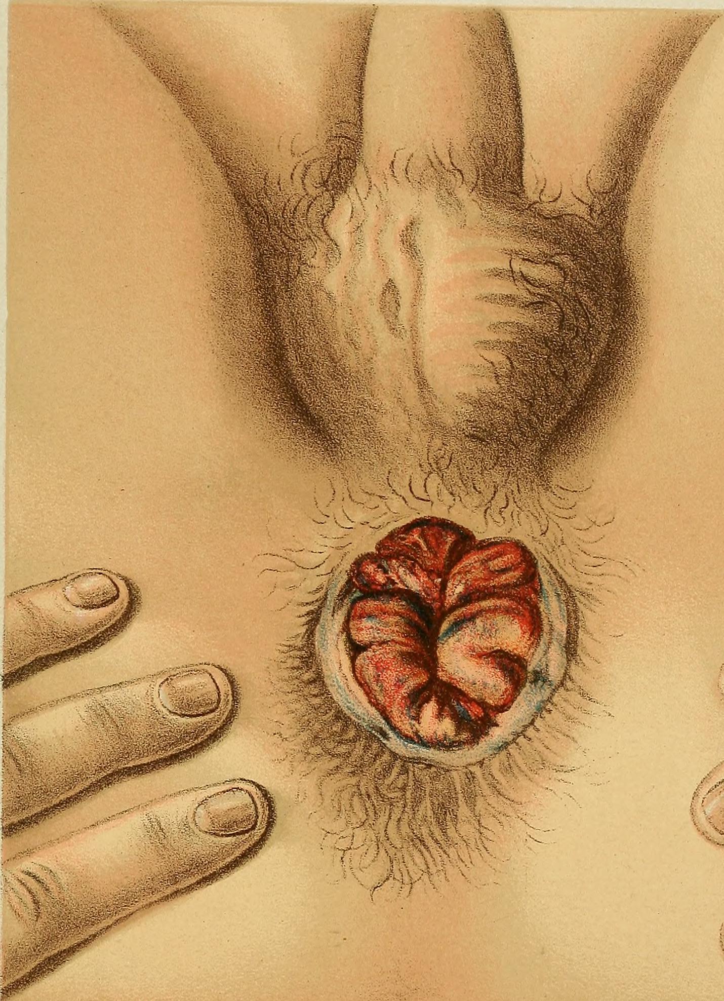 File:Hemorrhoids - By Internet Archive Book Images - httpswww.flickr.comphotosinternetarchivebookimages14784684835Source book page httpsarchive.orgstreamdiseasesofrectum00gantdiseasesofrectum00gant-pagen490mode1up, No restrictions, ht.jpg