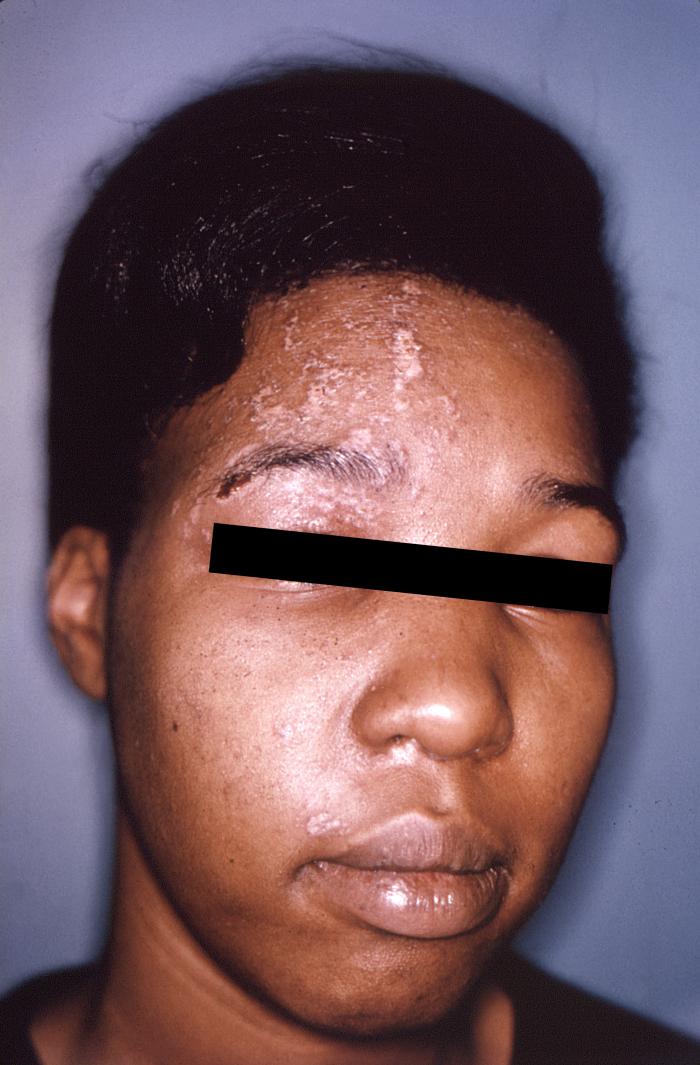 File:Herpes zoster 10.jpg