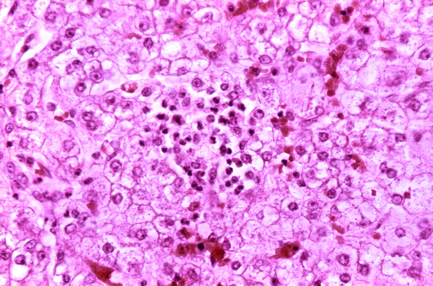 File:Reye's syndrome liver-histology.jpg