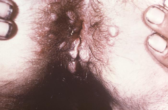 This image depicts the perineal region of a patient, who’d presented with what was described as moist papular and nodular perianal syphilids, due to what was diagnosed as a case of secondary syphilis. The secondary stage of syphilis is characterized by the manifestation of a skin rash and mucous membrane lesions. This stage typically starts with the development of a rash on one or more areas of the body. The rash usually does not cause itching. Rashes associated with secondary syphilis can appear as the chancre is healing or several weeks after the chancre has healed. The characteristic rash of secondary syphilis may appear as rough, red, or reddish brown spots both on the palms of the hands and the bottoms of the feet. However, rashes with a different appearance may occur on other parts of the body, sometimes resembling rashes caused by other diseases. Sometimes rashes associated with secondary syphilis are so faint that they are not noticed. In addition to rashes, symptoms of secondary syphilis may include fever, swollen lymph glands, sore throat, patchy hair loss, headaches, weight loss, muscle aches, and fatigue. The signs and symptoms of secondary syphilis will resolve with or without treatment, but without treatment, the infection will progress to the latent and possibly late stages of disease. Adapted from CDC