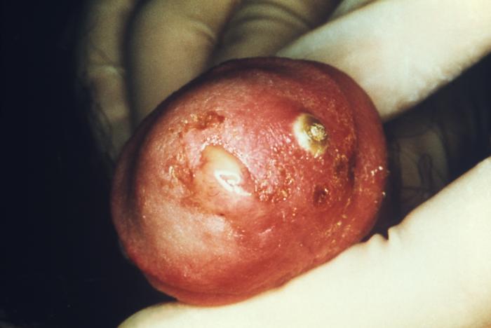 This male presented with purulent penile discharge due to gonorrhea with an overlying penile pyodermal lesion. Pyoderma involves the formation of a purulent skin lesion as in this case located on the glans penis, and overlying the sexually transmitted disease gonorrhea. Adapted from CDC
