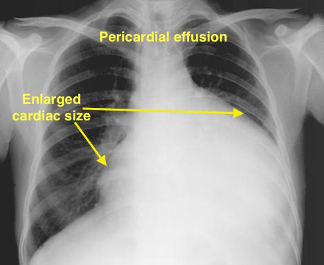 File:Pericardial effusion-1.jpg