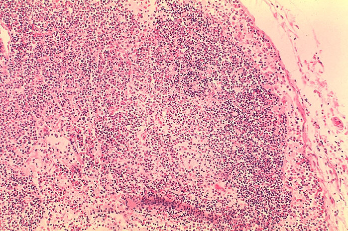 Histopathology of lymph node in fatal human plague. Focal cortical necrosis. Adapted from Public Health Image Library (PHIL), Centers for Disease Control and Prevention.[19]