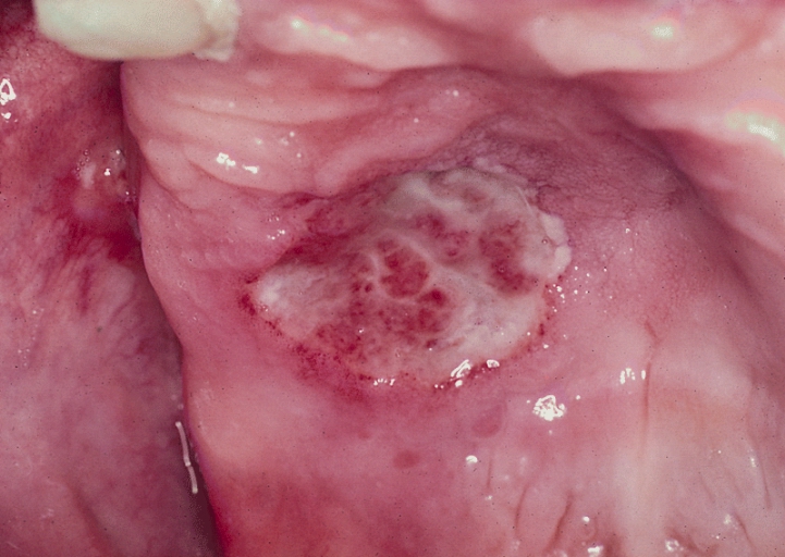 SALIVARY GLANDS: NECROTIZING SIALOMETAPLASIA. A 2-to 3-cm unilateral ulcer of the hard palate that is slow to heal is a common clinical presentation for necrotizing sialometaplasia.