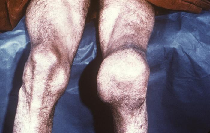 This photograph depicts the destruction of a patient’s left knee joint, which was determined to be a case of neuropathic arthropathy, also known as Charcot’s joint, brought on by a tertiary syphilitic infection. See PHIL 12606, for a radiographic view (x-ray) of a patient's knee with this arthritic deformity. Late and Latent Stages: The latent (hidden) stage of syphilis begins when primary and secondary symptoms disappear. Without treatment, the infected person will continue to have syphilis even though there are no signs or symptoms; infection remains in the body. This latent stage can last for years. The late stages of syphilis can develop in about 15% of people who have not been treated for syphilis, and can appear 10-20 years after infection was first acquired. In the late stages of syphilis, the disease may subsequently damage the internal organs, including the brain, nerves, eyes, heart, blood vessels, liver, bones, and joints. Signs and symptoms of the late stage of syphilis include difficulty coordinating muscle movements, paralysis, numbness, gradual blindness, and dementia. This damage may be serious enough to cause death. Adapted from CDC