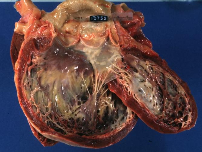 Dilated Cardiomyopathy: Gross opened dilated left ventricle with endocardial thickening