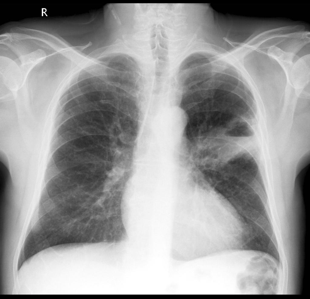 Squamous cell lung cancer: lung cavitating mass left upper lobe adjacent to the oblique fissure. The prominent air-fluid level is best seen on the lateral radiograph. Case courtesy of A.Prof Frank Gaillard. Source: Radiopaedia.org[3]